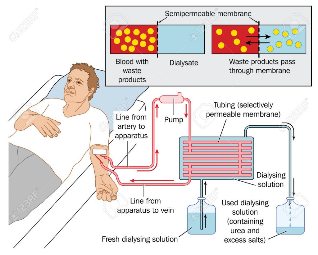 Dialysis Procedure Step By Step