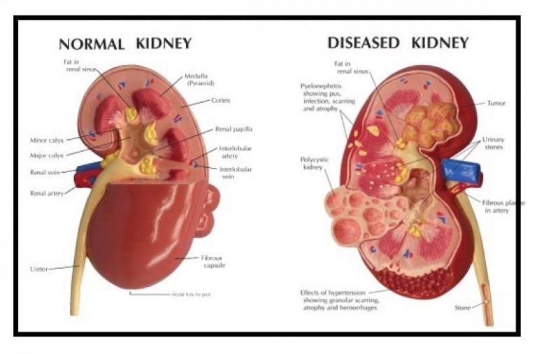 kidney-failure-treatment-in-delhi-india